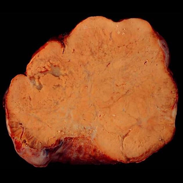 U Krukenberg (Krukenberg tumor)