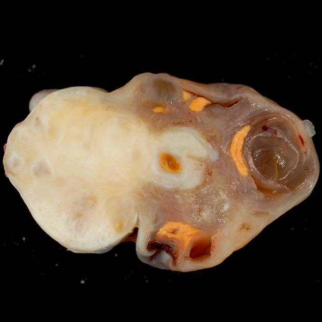 U sợi buồng trứng (Ovarian fibroma)