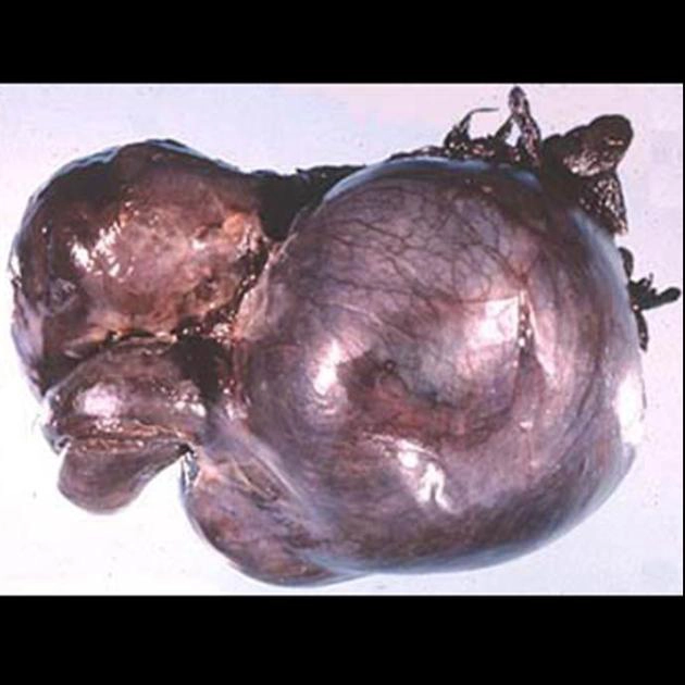 Xoắn buồng trứng - phần phụ (Adnexal torsion)