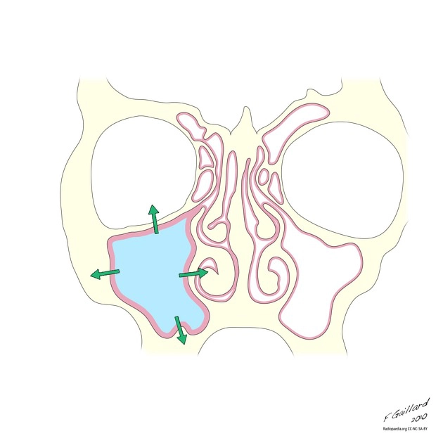 Ứ nhầy xoang (Paranasal sinus mucoceles)