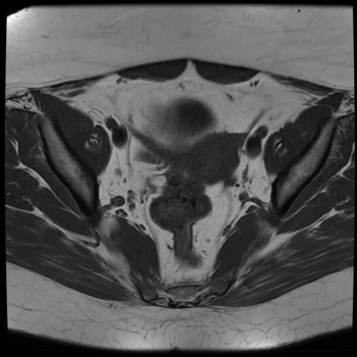 U tế bào hạt của buồng trứng (Granulosa cell tumor of the ovary)