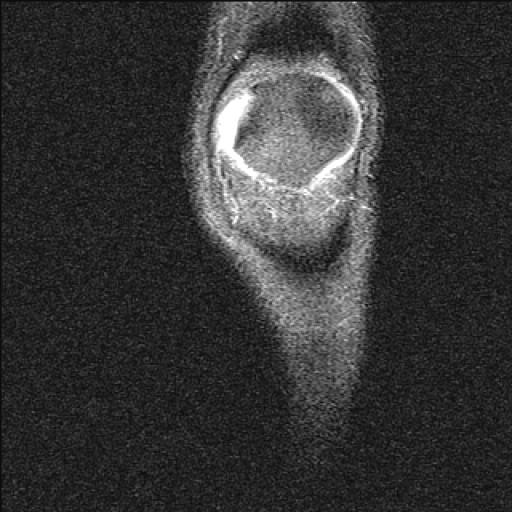 Dập tủy xương (Bone bruise)