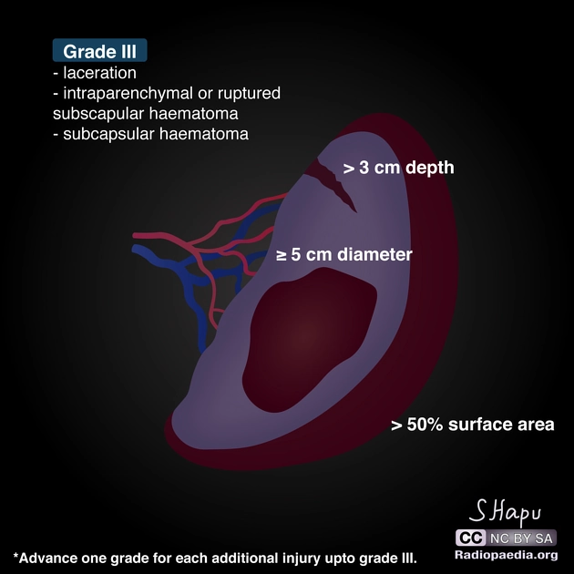 Phân độ chấn thương lách (AAST spleen injury scale)