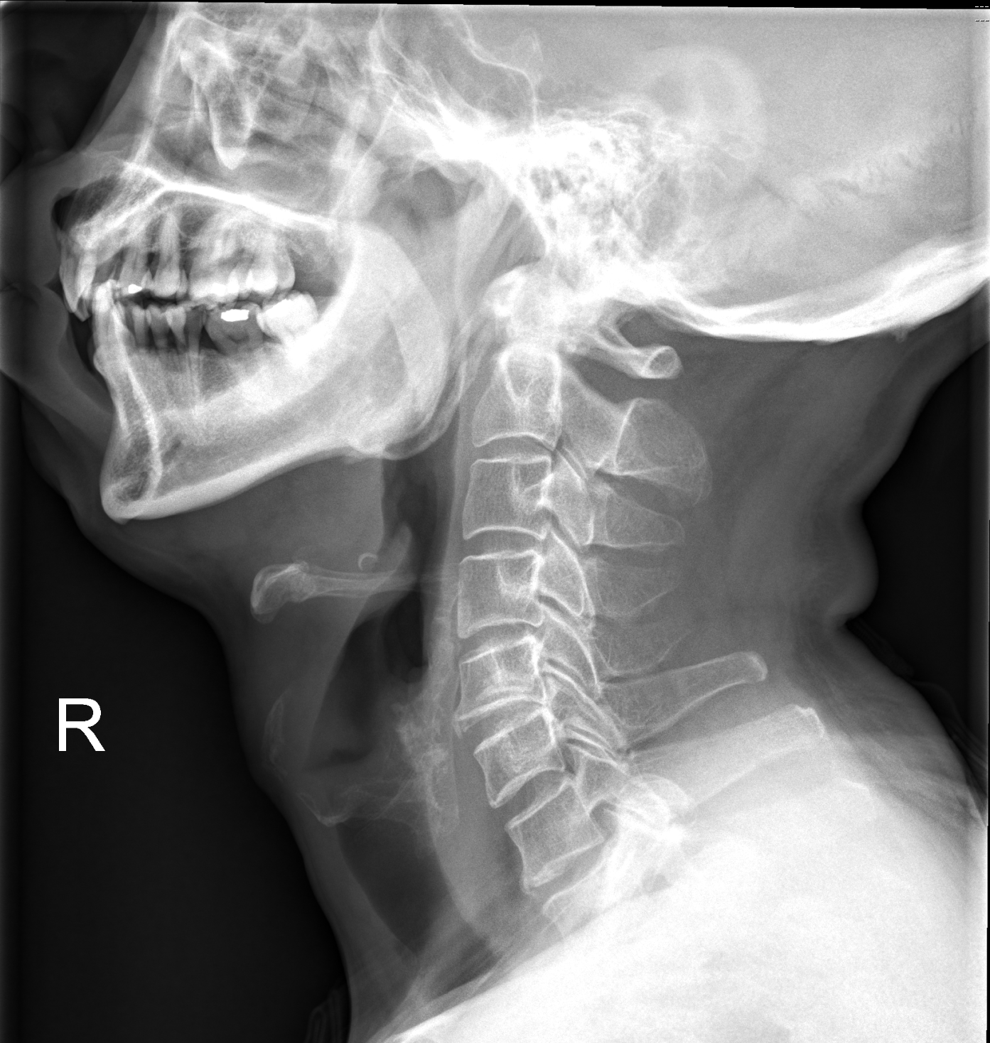 Dị vật xương nuốt phải (Ingested bones)
