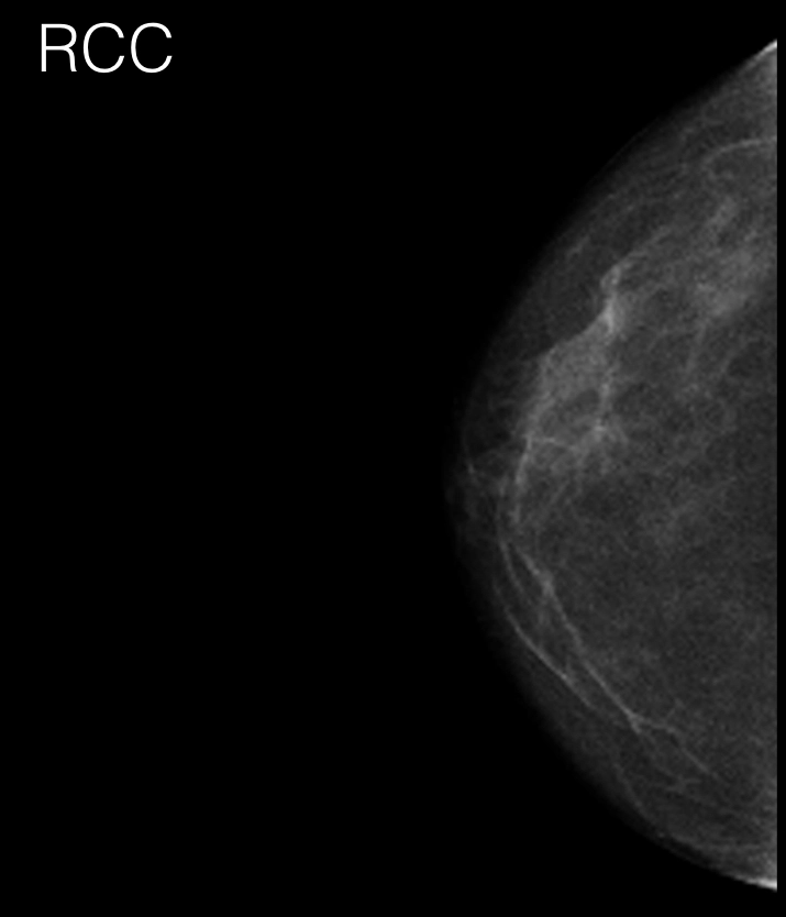 Nhũ ảnh 3D (Digital breast tomosynthesis - DBT)