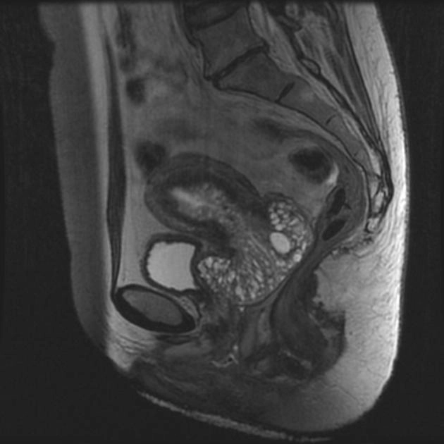 Ung thư tuyến cổ tử cung ít ác tính (Adenoma malignum of the cervix)