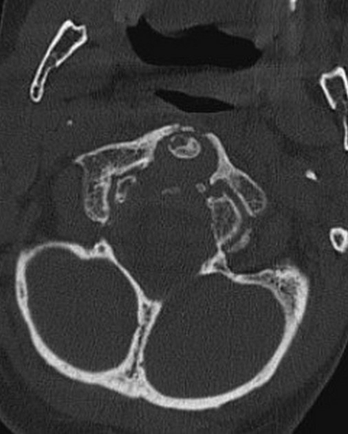 Bệnh lắng đọng Calci Pyrophosphate Dihydrate (CPPD)/Giả Gout (Pseudogout)