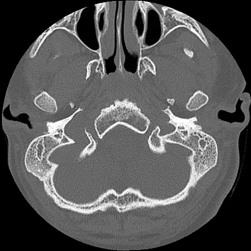 Loạn sản ống bán khuyên (Semicircular canal dysplasia)