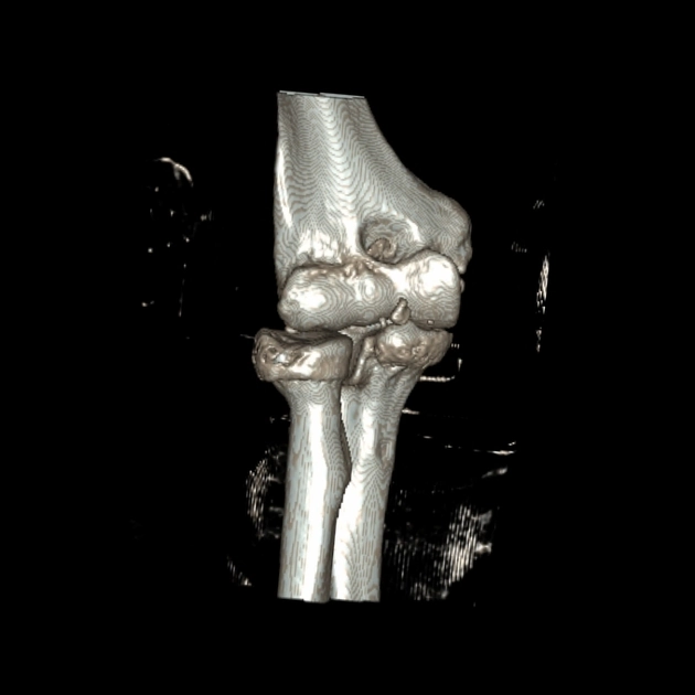 Hội chứng chẹn sau của khuỷu (Posterior Impingement, Elbow)/Hội chứng quá duỗi mỏm khuỷu (Valgus Extension Overload- VEO)