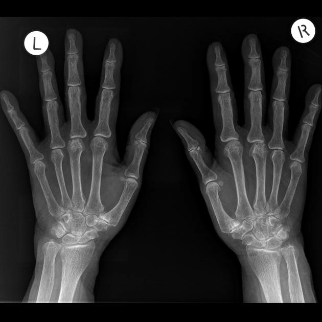 Hoại tử vô mạch chỏm xương bàn tay (Mauclaire disease)