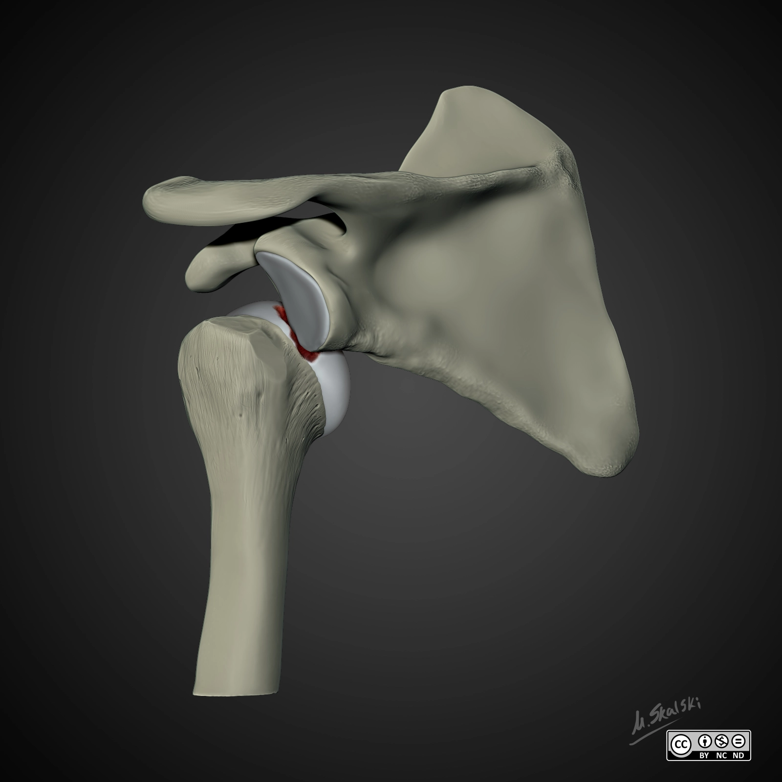 Tổn thương Hill-Sachs (Hill-Sachs Defect)