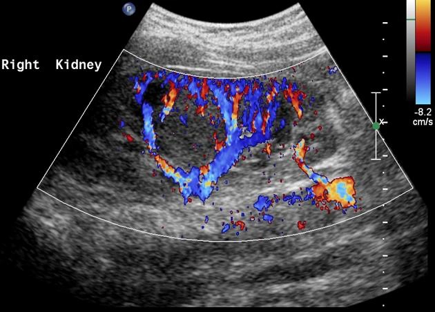 Cột Bertin phì đại (Hypertrophied column of Bertin)