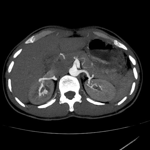 Dị dạng động-tĩnh mạch thận (Renal Arteriovenous Malformation - AVM)