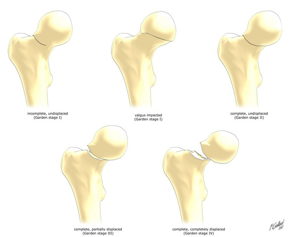 Phân loại Garden gãy cổ xương đùi