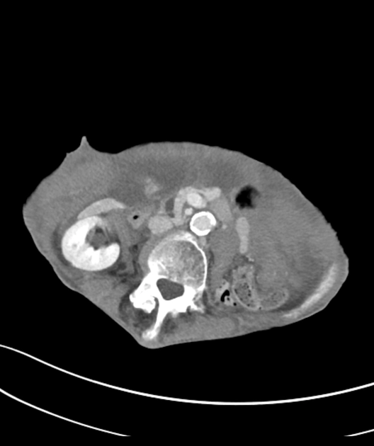 Xoắn túi mật (Gallbladder volvulus)