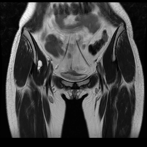 Nang cạnh sụn viền khớp háng (Paralabral cyst of the hip joint)