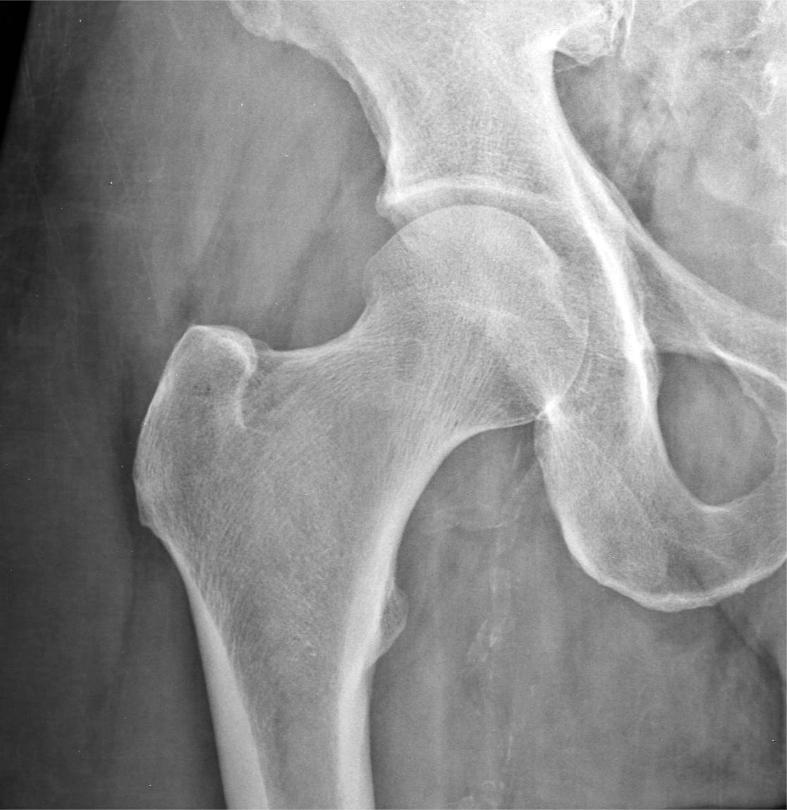 Hố thoát vị màng hoạt dịch cổ xương đùi (Synovial herniation pit)
