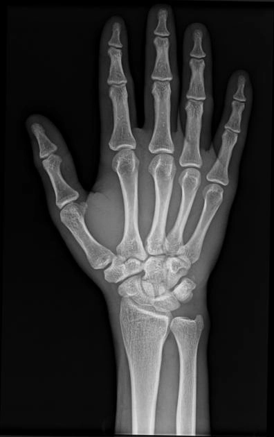 Gãy xương cả (Capitate fracture)