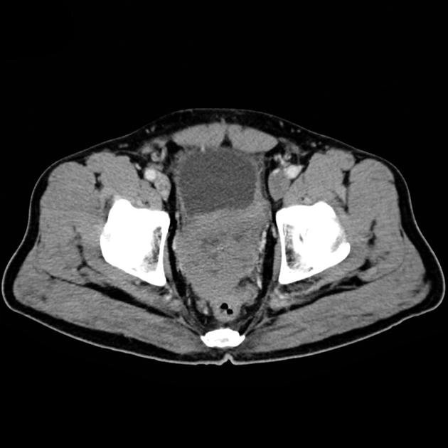 Sarcoma tuyến tiền liệt (Prostate sarcoma)