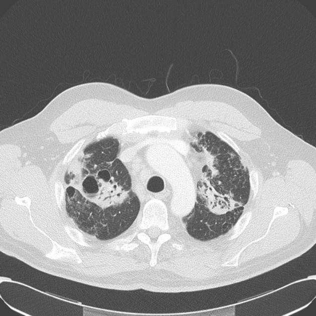 Viêm cột sống dính khớp (Biểu hiện ở phổi) - (Ankylosing spondylitis- thoracic manifestations)