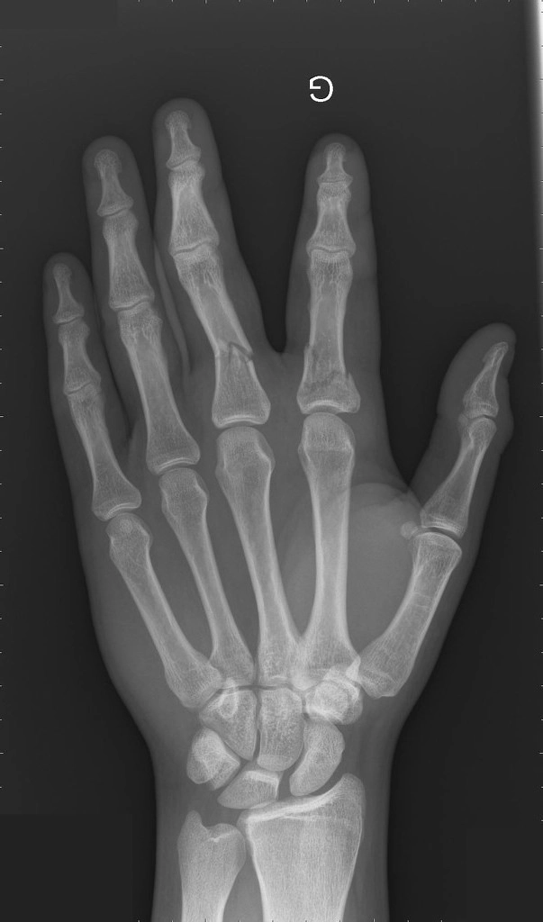 Gãy xương ngón tay đốt gần (Proximal phalanx fracture)