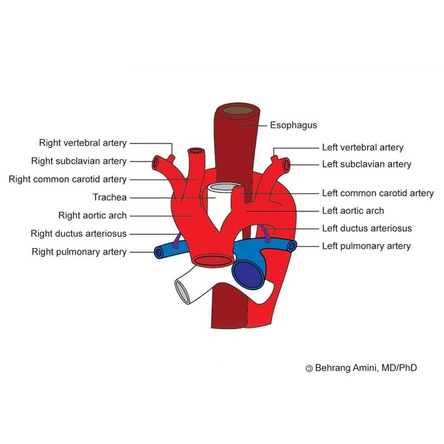 Cung động mạch chủ đôi (Double aortic arch)