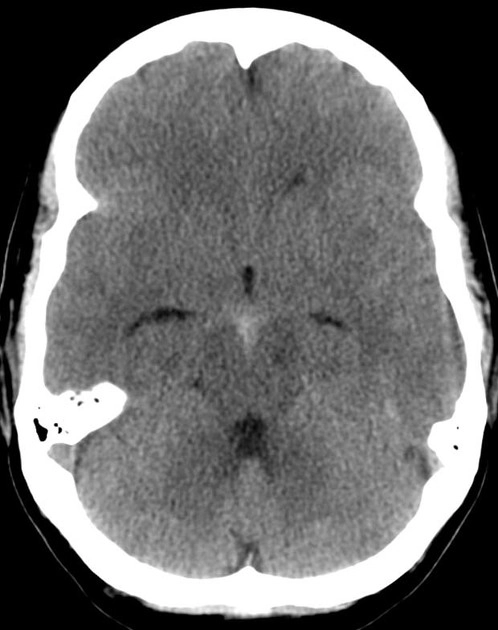 Xuất huyết dưới nhện quanh trung não không do phình mạch (Perimesencephalic Nonaneurysmal Subarachnoid Hemorrhage - pnSAH)
