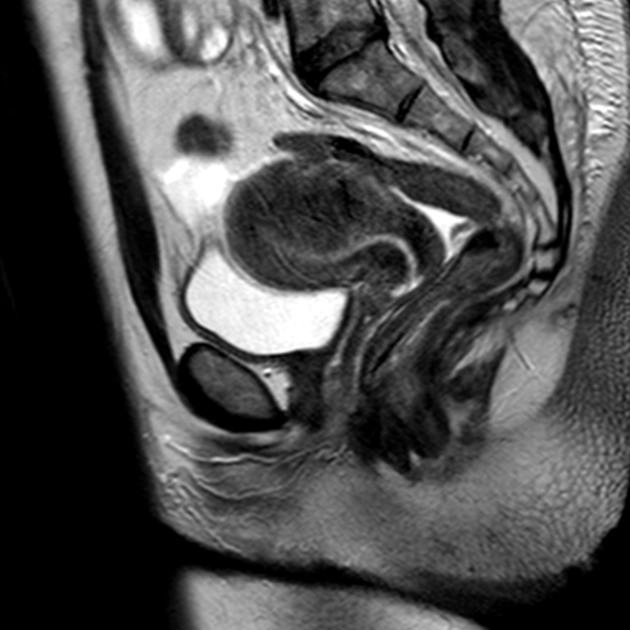 U cơ tuyến (Adenomyoma)