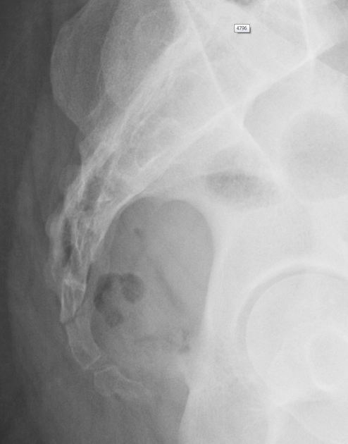 Gãy xương cụt (Coccygeal fracture)