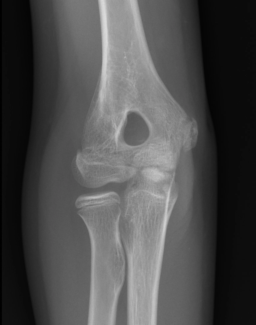 Lỗ mỏm khuỷu (Olecranon foramen)