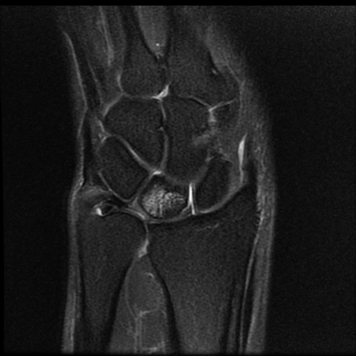 Hội chứng kẹt xương trụ (Ulnar impaction syndrome)