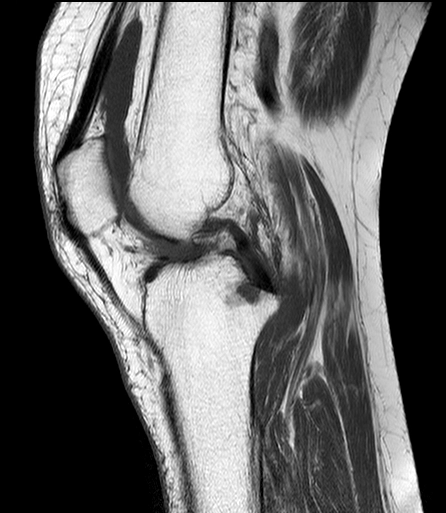 Nang hạch trong xương (Intraosseous ganglion)