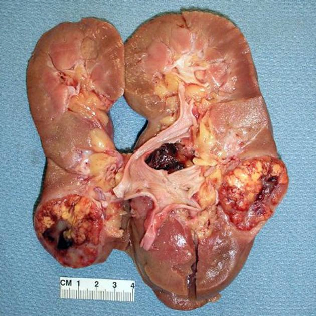 Ung thư biểu mô tế bào thận (Renal Cell Carcinoma - RCC)