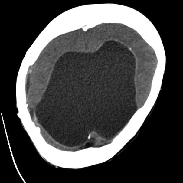 Não úng thủy tắc nghẽn ở não thất (Obstructive Hydrocephalus) 