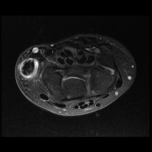 Viêm bao gân De Quervain (De Quervain tenosynovitis)