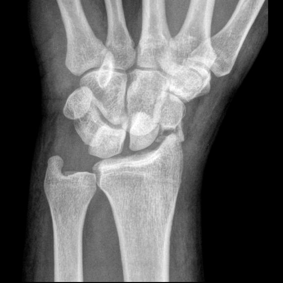 Phân loại Mayfield về mất vững khối xương cổ tay (Mayfield classification of carpal instability)