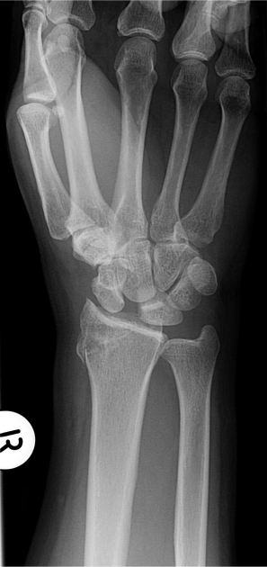 Đứt dây chằng thuyền-nguyệt (Scapholunate ligament tear)