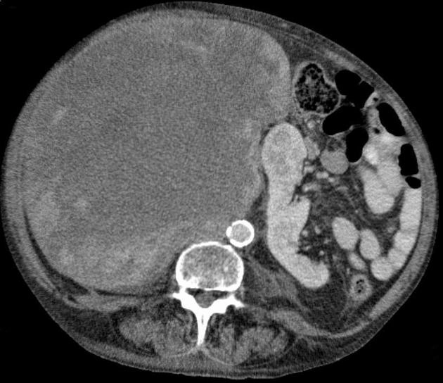 Sarcoma mỡ sau phúc mạc (Retroperitoneal liposarcoma)