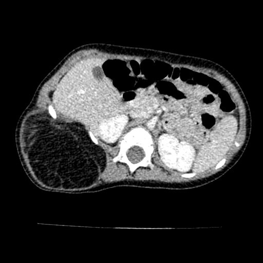 U nguyên bào mỡ (Lipoblastoma)