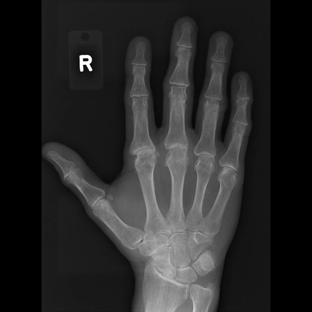 Bệnh khớp do ứ đọng sắt (Hemochromatosis arthropathy) 