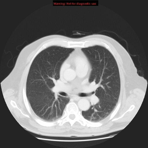 Bệnh phổi do thuốc (Drug-induced lung disease)