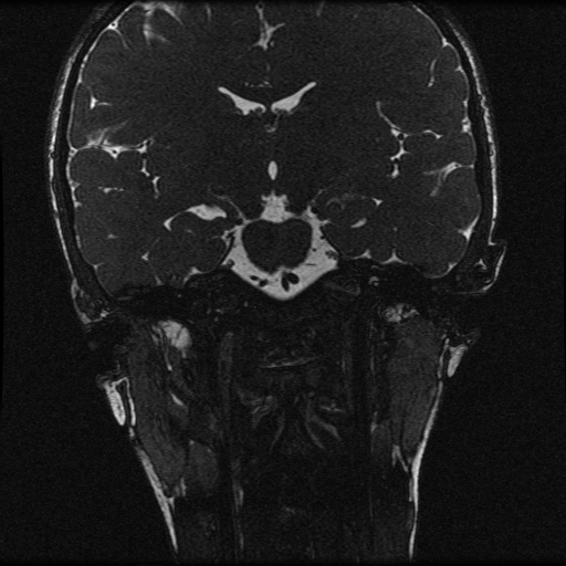 Phân chia không hoàn toàn ốc tai loại I (Cochlear incomplete partition type I)