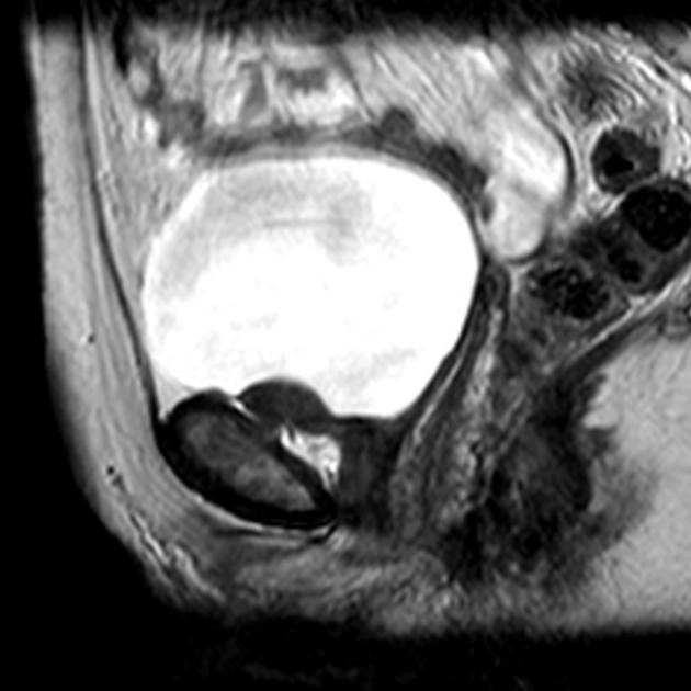 U cơ trơn bàng quang (Leiomyoma of the urinary bladder)