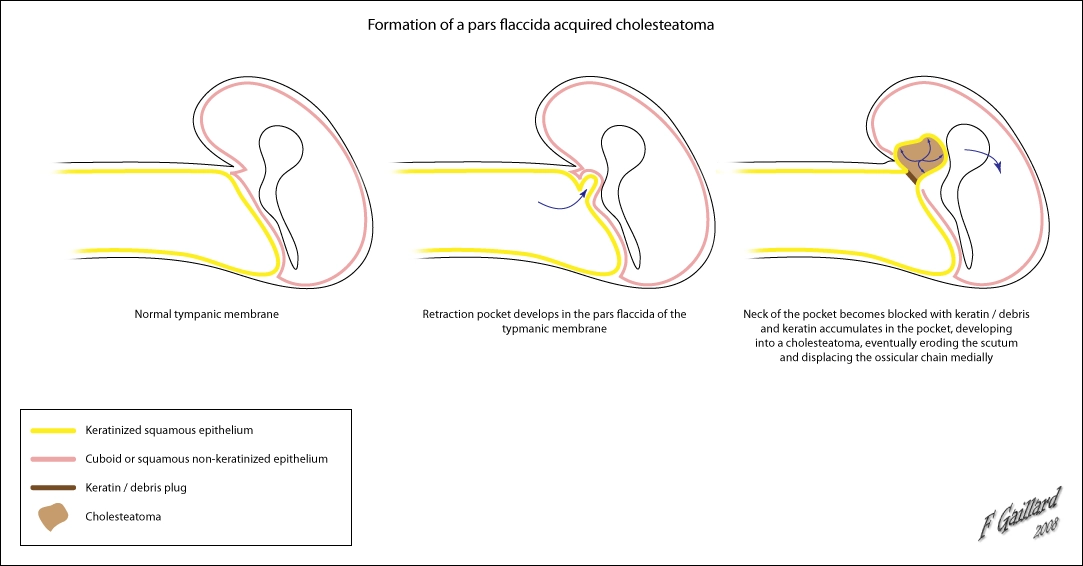 Cholesteatoma mắc phải (Acquired cholesteatomas)