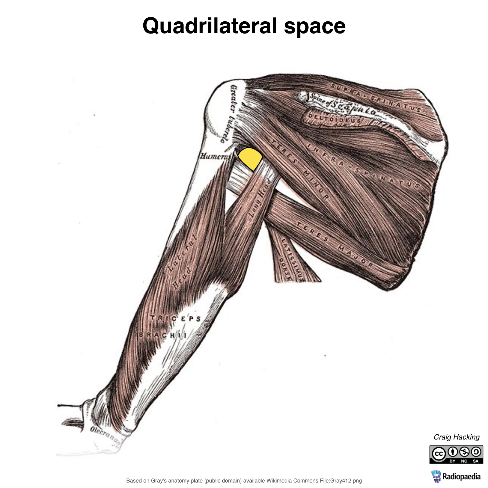 Hội chứng khoang tứ giác (Quadrangular space syndrome - QSS)