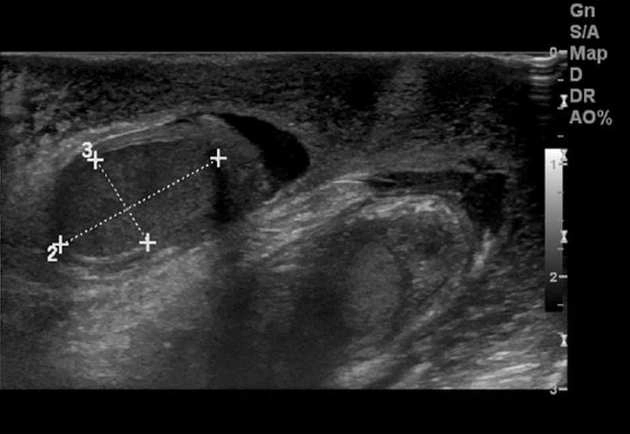 Phù bìu cấp tính vô căn (Acute Idiopathic Scrotal Edema)