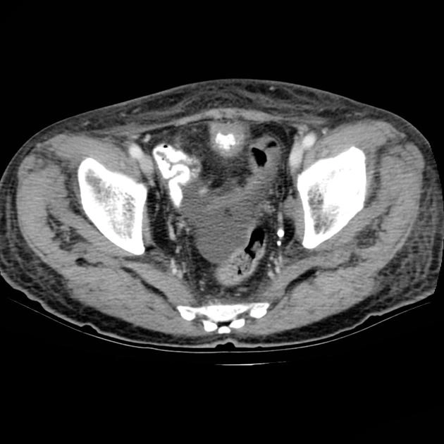 Ung thư biểu mô tuyến của bàng quang (Adenocarcinoma urinary bladder)