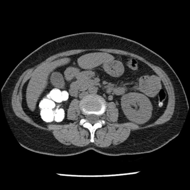 Lao thận (Renal tuberculosis)