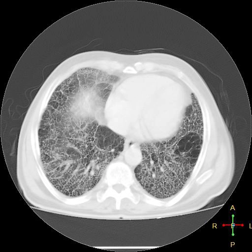 Xơ phổi vô căn (Idiopathic pulmonary fibrosis - IPF)/Viêm phổi kẽ thông thường vô căn (Idiopathic usual interstitial pneumonia - UIP)