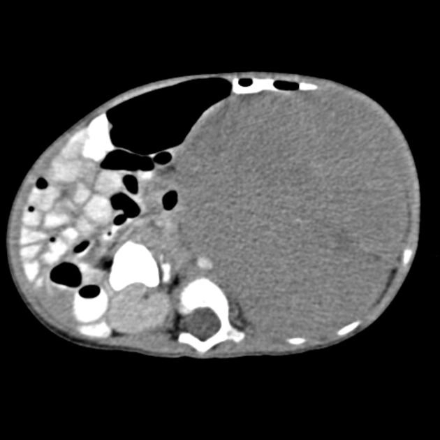 U nguyên bào thần kinh ở trung thất (Neuroblastoma)